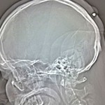 Man doesn’t notice being shot in head