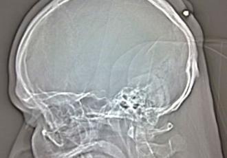 Man doesn't notice being shot in head